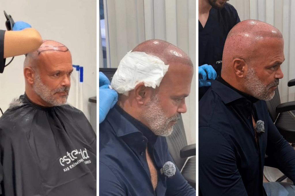 Niet Voor Hergebruik Haartransplantatie Denny Braaf